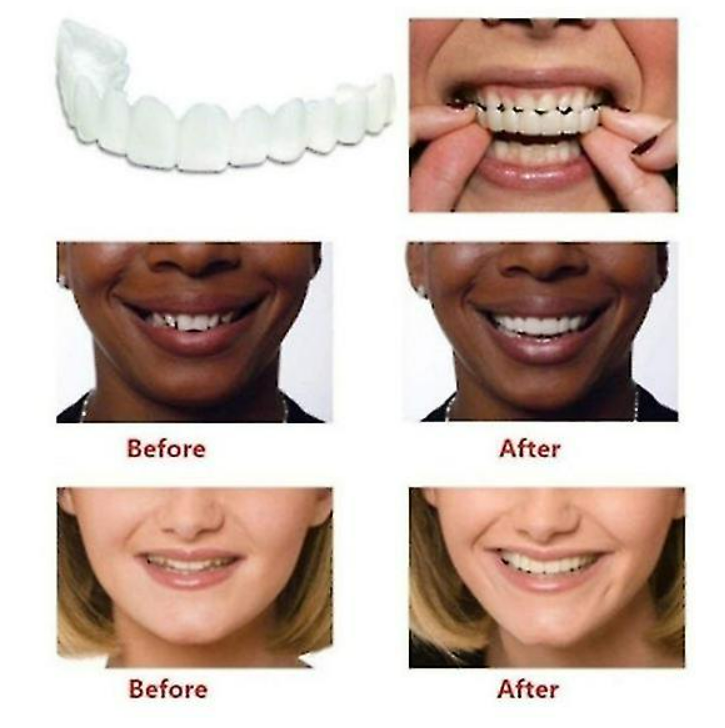 Snap On Veneers Instant Adjustable Bottom And Upper Dentures